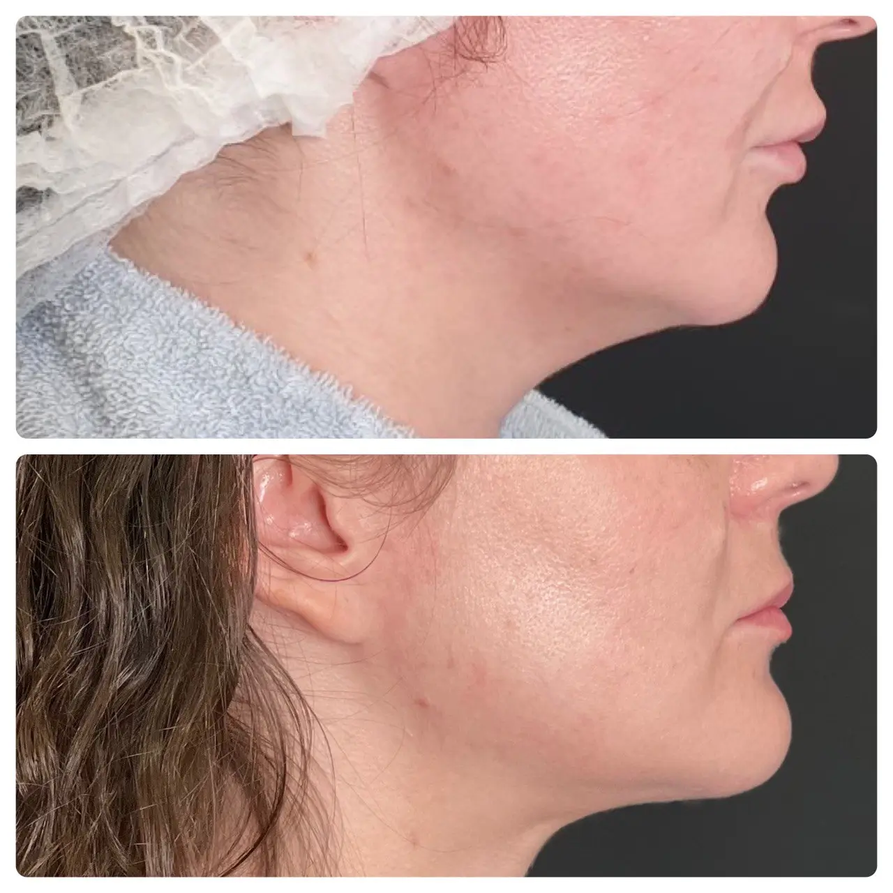 facetite2