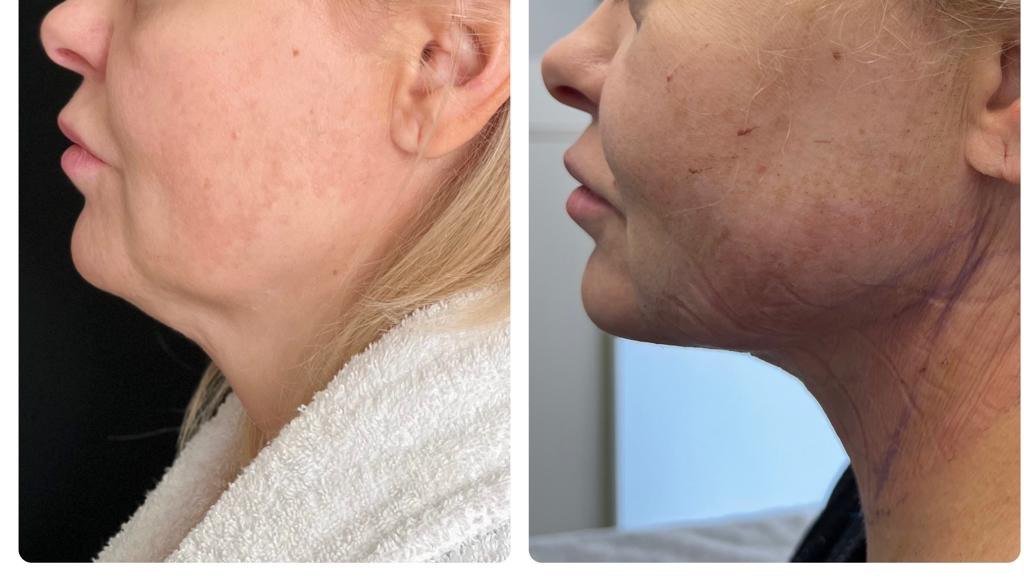 facetite1