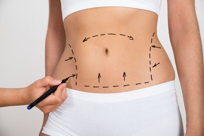 39679309 - person hand drawing lines on a woman's abdomen as marks for abdominal cellulite correction