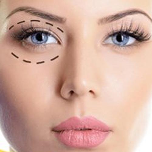 blefaroplastika_plastika_vek-1