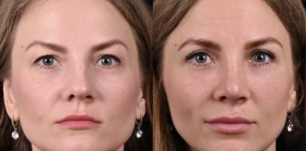 blefaroplastika-vek-1024x507