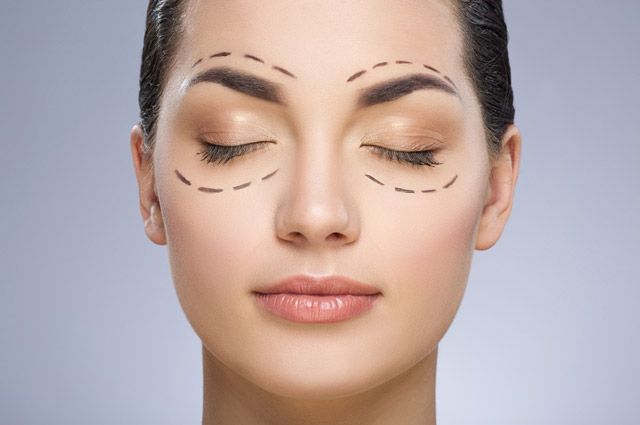 rezultat-blefaroplastiki-1